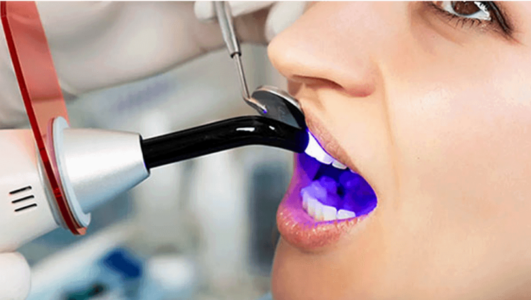 Teeth Whitening