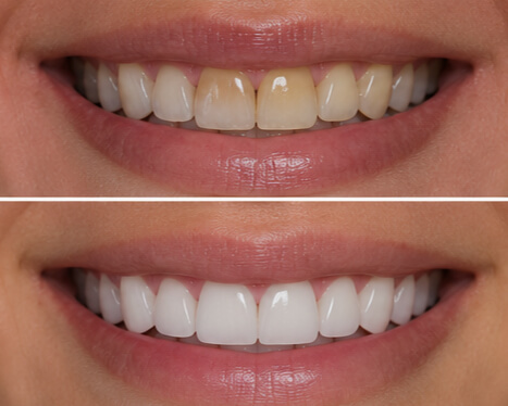 Discoloration correction