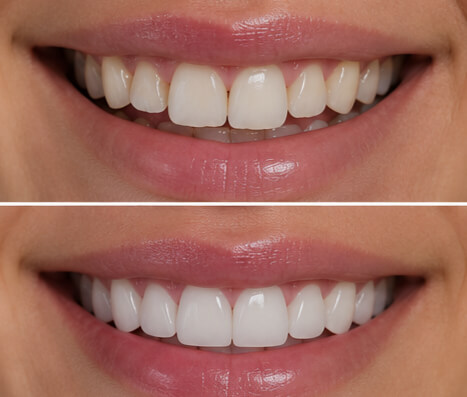 Porcelain veneers — 6 front teeth
