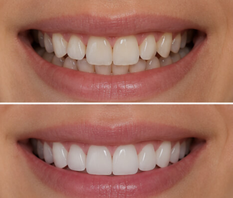 Veneers + Invisalign combination case